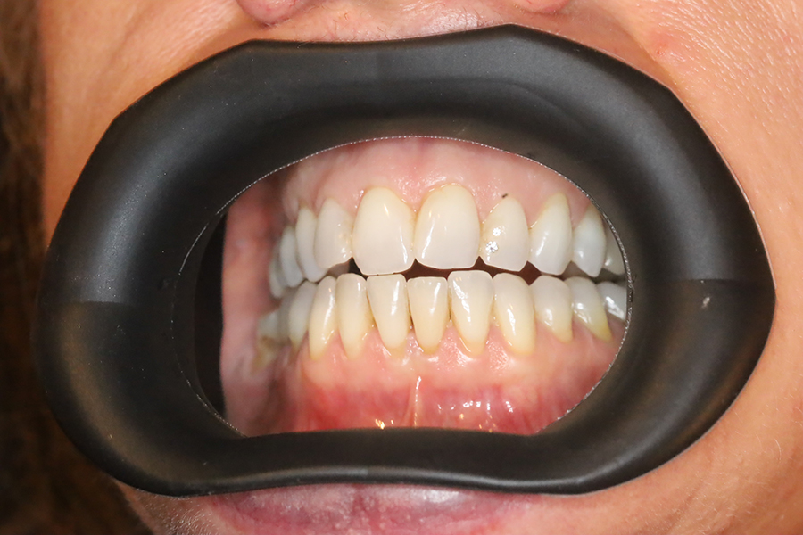mouth-retractors-dentists